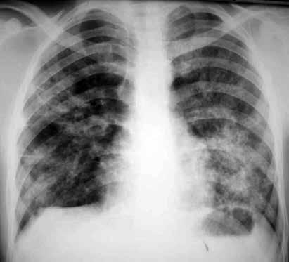 Yaygın kciğer Hastalıklarında Radyografi 85 pnömonitisi, akciğer kontüzyonu ve adenokarsinomda (bronkoalveolar karsinom) gelişebilir.