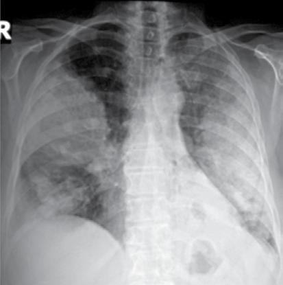 Yaygın kciğer Hastalıklarında Radyografi 87 NOKT Resim 10.,. () denokarsinom tanılı hastada iki taraflı konsolidasyon alanları izlenmektedir.