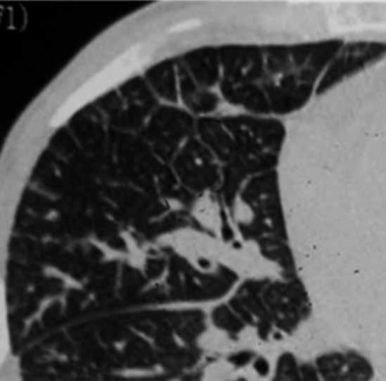 () T de izlenen interlobüler septa kalınlaşmaları (oklar) radyografide Kerley çizgilerini oluşturmakta. Resim 12.,. () ronş ve arter akciğer parankiminde yan yana ilerler.