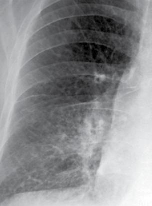 Yaygın kciğer Hastalıklarında Radyografi 89 NOKT Resim 13.,.