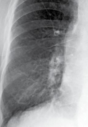 başları), inen sağ pulmoner arter duvarında belirsizleşme (kalın oklar)görülüyor. u bulguların tümü interstisyel bir tutulumu düşündürüyor.