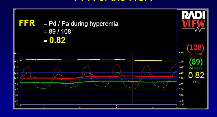 RCA FFR