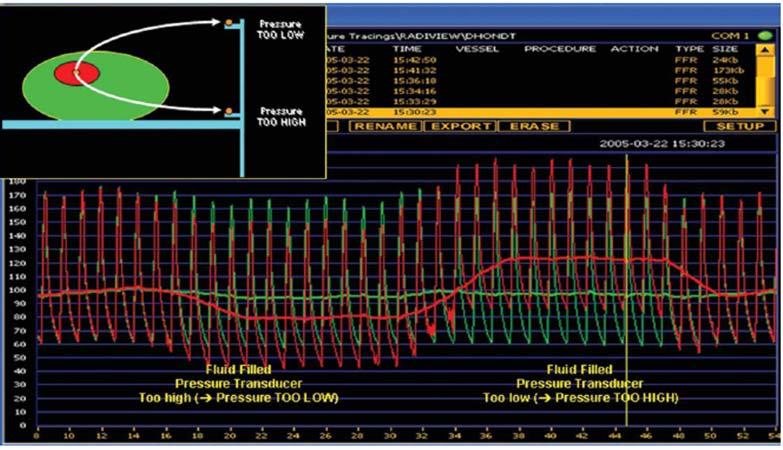 3.Basınç transducer aortik root