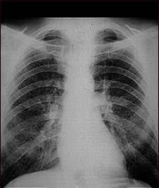 Akciğer grafisi SİLİKOZİS Erken bulguları yakalamak için