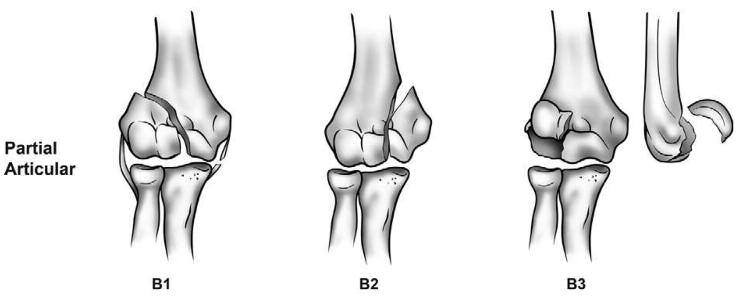 2 KLİNİK DEĞERLENDİRME Klasik olarak tüm kırık olgularında olduğu gibi distal humerus kırıklarınıda değerledirirken aynı taraf alt ve üst eklem bölgeleri yani aynı taraf el bilek ve omuz eklemide