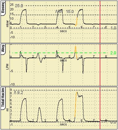 11. Çevrimler, Trendler ve Dalga Formları Bu bölümde ventilatörün hasta verilerini nasıl görüntülediğinin ayrıntıları verilmiştir.