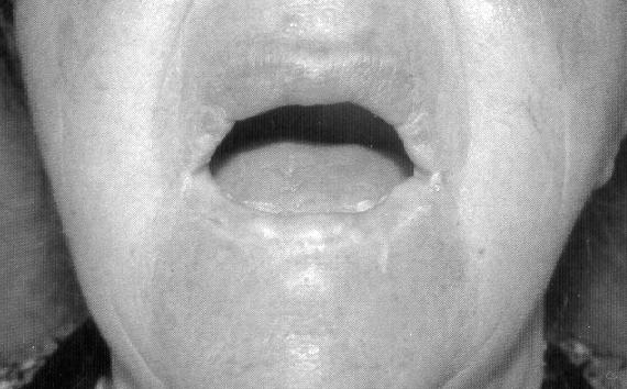 görünüm; : lt dudak orta bölgesinde bulunan skar