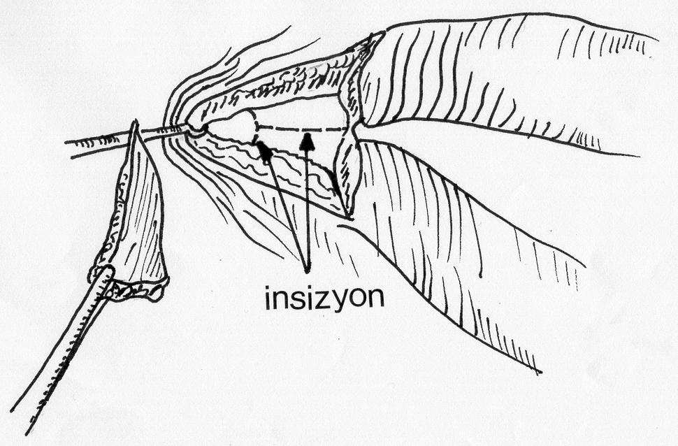 ve mukoza insizyonlarýnýn görünümü; : Oral mukoza insizyonu ile süperior, inferior ve lateral mukoza