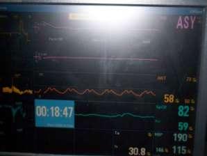 Nabız hızı (pulse rate): 60 atım/dk, Nabız genişliği (pulse width): %60 ve Bazal akım