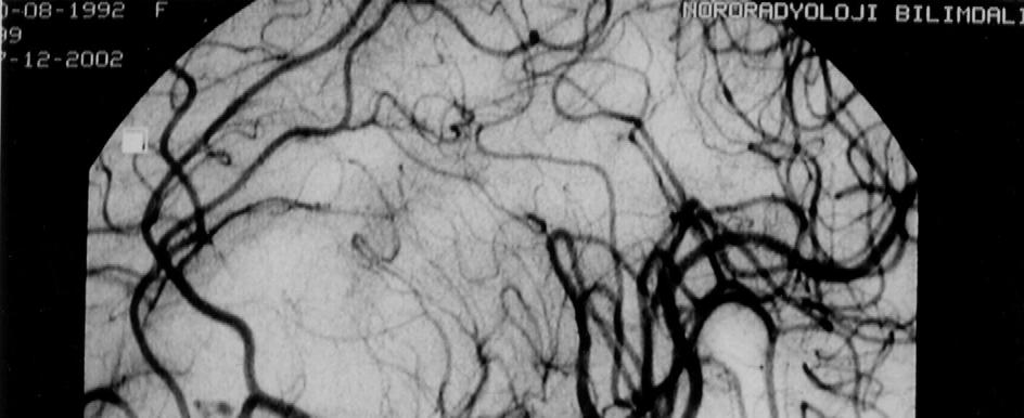 Hastanın kraniyal aksiyal BT incelemesinde sol frontal lobda ak maddeye lokalize büyük lobar intraparenkimal hematom ve ak maddede ödem alanı görüldü (Resim 2A).