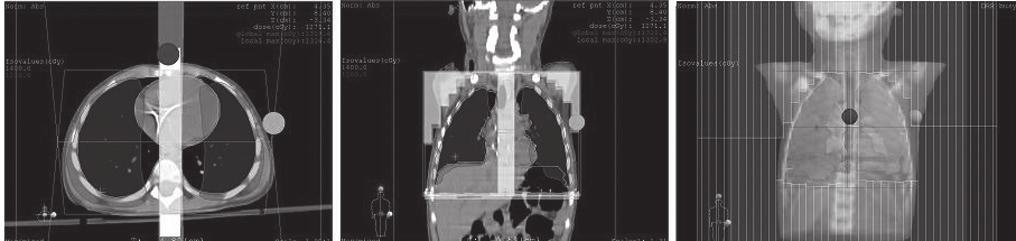 Wilms tümörü akciğer metastastazlı olguda bilateral akciğer ışınlaması (a) (b) (c) Şekil 2. AP-PA ışınlamasına aksiyel (a) ve koronal (b) kesitteki demet yerleşimi ve doz dağılımı. (c) MLC yerleşimi.