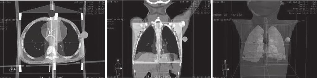 hattına normalize edilerek akciğerlerin kapsanma oranı arttırılmıştır. Şekil 3 de bu plana ait demet yerleşimi ve doz dağılımı gösterilmektedir. c.