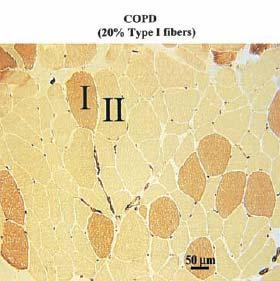 changes Atrophy Apoptosis