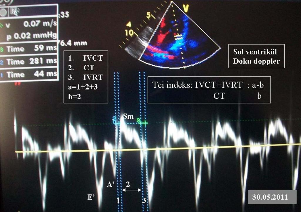 Şekil 5: Sol ventrikül doku Doppleri ve Tei indeksi ölçülmesi.