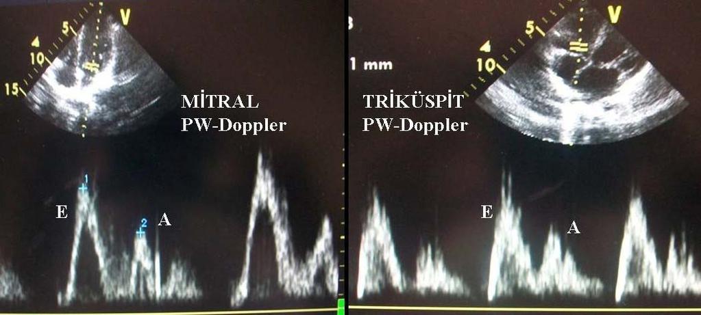 pulsed Doppler ile elde edildi. Işının kan akımına paralel gelmesinde renkli Doppler yol gösterici olarak kullanıldı.