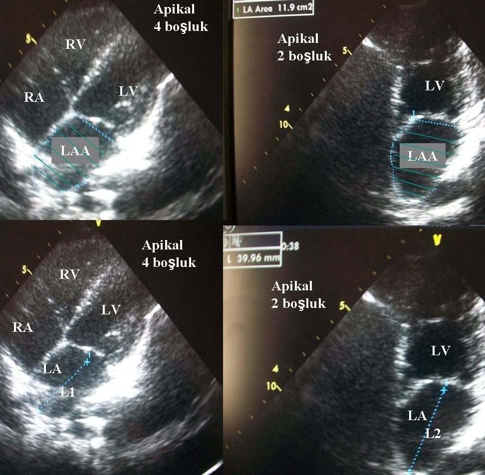 alındı. Sol atriyumun apikal 4 ve 2 boşlukta alan ve uzun aks ölçümleri Şekil 10 da sunulmuştur. Şekil 10. Sol atriyumun apikal 4 ve 2 boşluk görüntülerinde alan ve uzunluk ölçümleri.