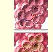Bakteriyel pnömoni Kolonizasyon İnflamatuvar cevap Alveolar ödem ve eksuda formasyonu Alveoller ve