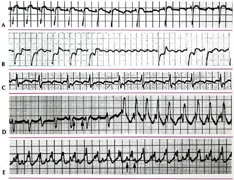 Atrial flatter