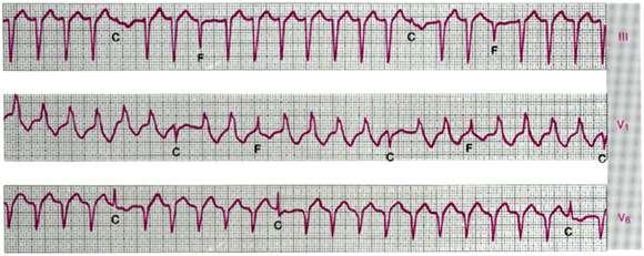 Ventriküler taşikardi QRS