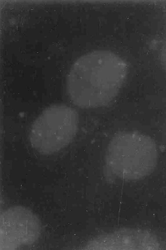 Forslund ve arkadaşları 123 hastada yaptıkları bir çalışmada, moleküler genetik metotlarla heterozigosite kaybını (loss of heterozygosity: LOH) değerlendirmişlerdir.