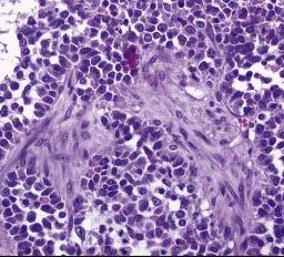 Hiperkalemik tip küçük hücreli karsinom Östrojenik semptom (-) Dar sitoplazma, küçük hücre baskın Sıklıkla Ca +2 yüksek