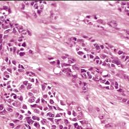 Desmoplastik yuvarlak hücreli tümör Tümör hücreleri yuvalar halinde desmoplastik stroma ile ayrılmış