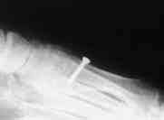 Osteotomi hatt, birinci metatars n distal fragman n n dorsifleksiyonda aç lanmamas na dikkat edilerek bir adet 3.5 mm lik kortikal vida ile fikse edilir (fiekil 1, 2).