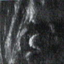 Ultrasonografik morfoloji Femoral ossifik nükleus Görülme yaşı 3-4 ay Her zaman femur başı merkezinde yer almaz USG