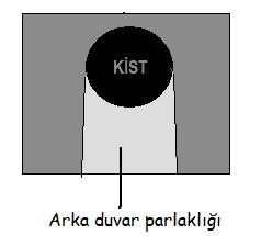 HEPATOSELÜLER KARSİNOM (HSK): Karaciğerin en sık görülen primer malign tümörüdür. Sirotik zemindeki kitlelerin % 80 i HSK dır.