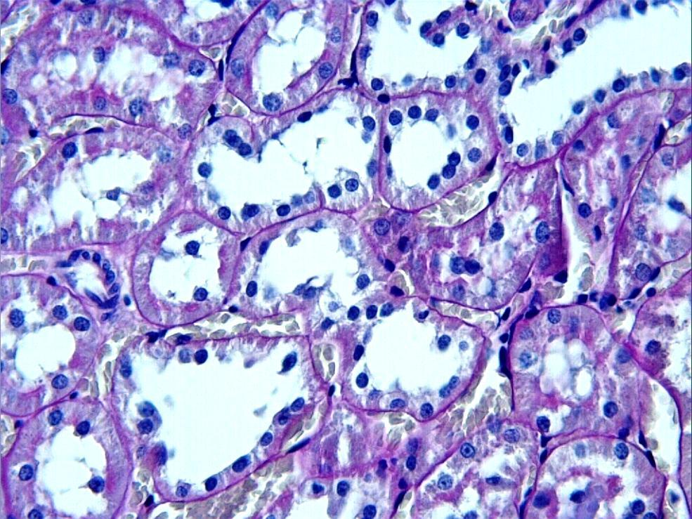 Resim 13. Diyabet grubu; proksimal tubul epitel hücrelerinin apikalinde mikrovillus kaybı görülmekte (oklar). PAS; X40.