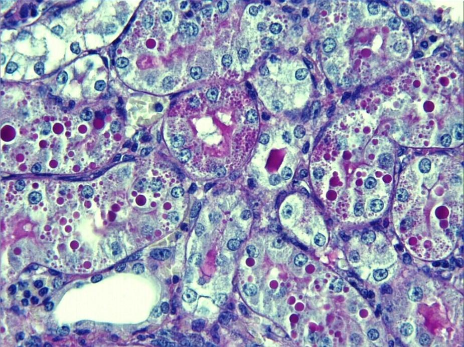 Diyabet grubu; tubuler bazal membran kalınlaşması dikkat çekiciydi Ayrıca etkilenmiş tubullerde epitel hücrelerinin