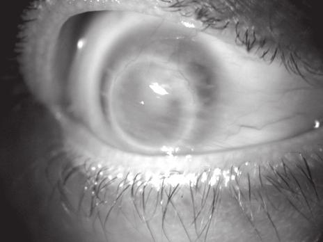 İlk muayenede tüm gözlerde hafiften ağıra kadar değişebilen derecelerde santral ya da parasantral kornea epitel defekti ve halka şeklinde stromal infiltrasyon, 7 gözde hipopyon ve 1 gözde stromal