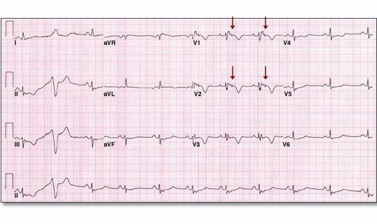 QRS kompleksinin sonunda ST segmentinin hemen başında küçük