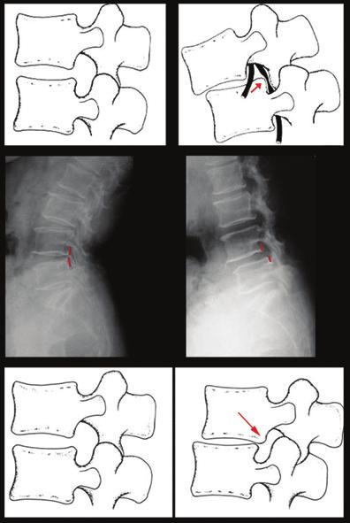 bolum5 4/8/11 3:19 PM Page 64 64 Lomber Dejeneratif Disk Hastal ve Dinamik Stabilizasyon 5- Afi KÂR (OVERT) NSTAB L TE LE KRON K NSTAB L TE ARASINDAK