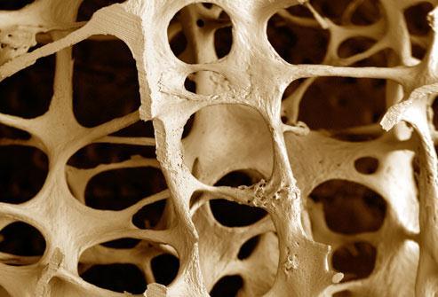 "Osteoporoz" Sistemik iskelet hastalığı Düşük kemik