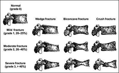 Osteoporoda Direkt Grafi Sırt ağrısı, boy kısalması, kifoz varsa vertebral kırık açısından değerlendirilmeli Lateral