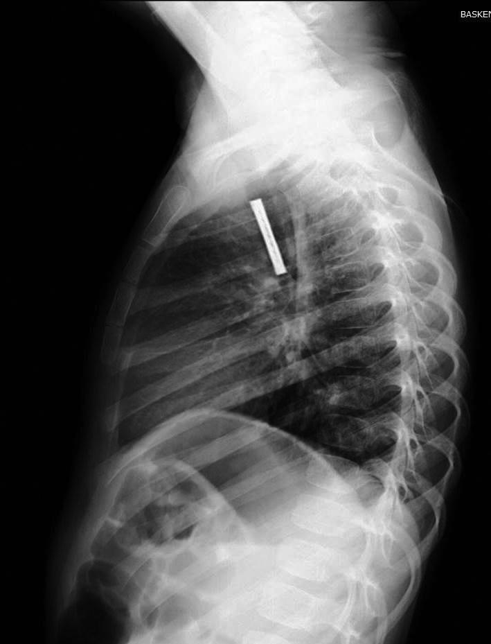 yapılabilir (Resim 6a,b). Hastaların %7 ile %30 unda akciğer grafisi normal olabilir (22,31).