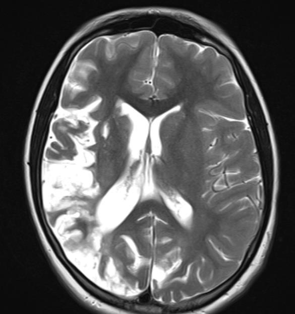 Beyin MR-MR Angiografi T2 sekansında oturmuş