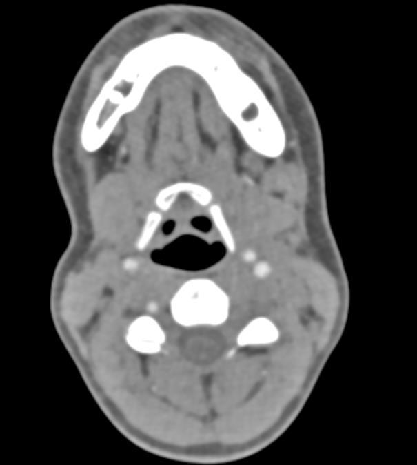 Sağ internal karotis arterinde