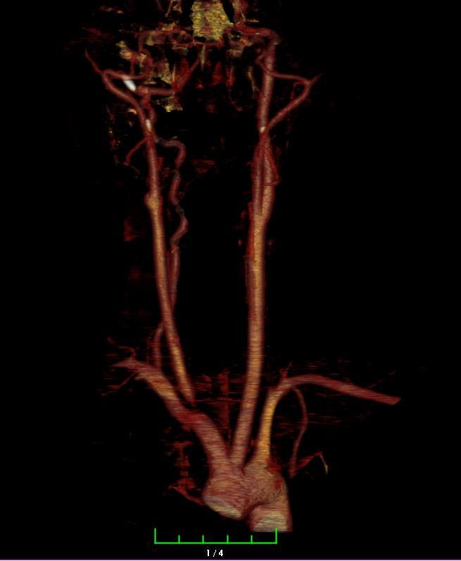 Beyin MR-MR Angiografi Sağ internal karotis