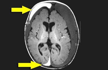 subdural hematom Sol ACA,MCA ve PCA