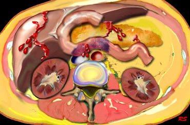 istismara bağlı abdominal