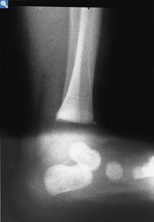 a a) 4 aylık,distal tibia metafiz köşe kırığı : eş zamanlı kemik taramasında tüm