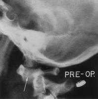 hasarı-kırık B bones: Her servikal dikkatli değerlendirilmeli D dens:predental