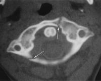 (a) C1 in axial BT si (b) üst