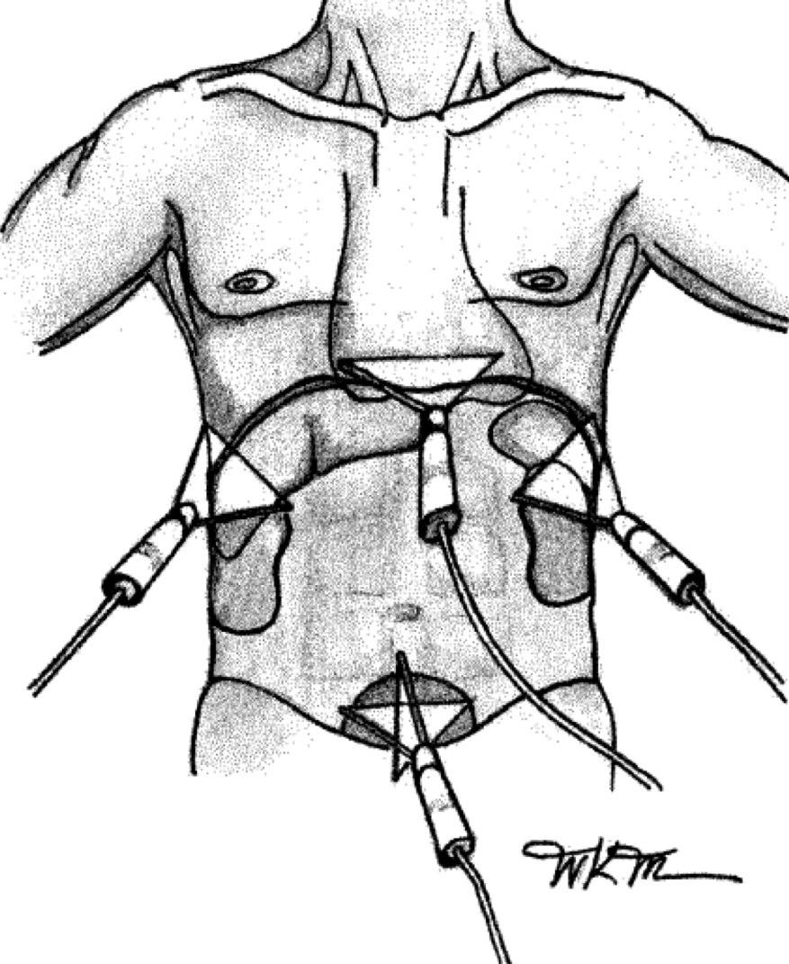 yağ dokusu az mesane dolu iken intraabdominal bir organ