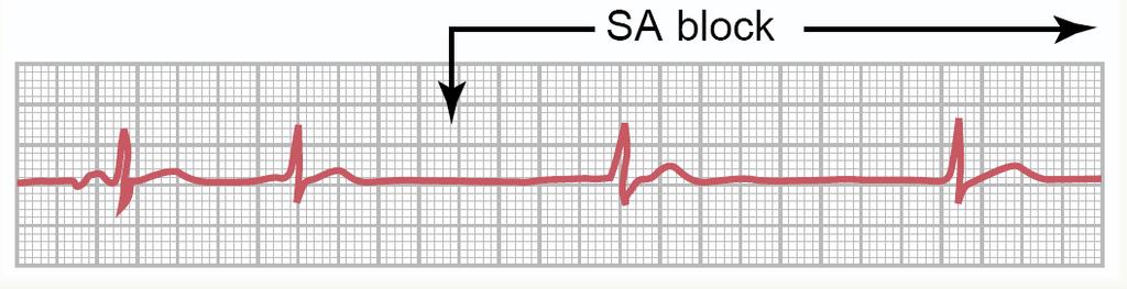 I. Kalp Blokları SA blok : SA düğümden uyaran çıkışında