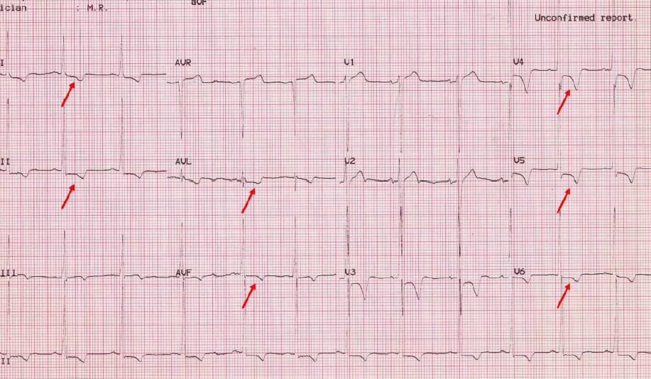 İzole LVH voltaj kriterlerinin (Sokolow-Lyon) yanında inferolateral