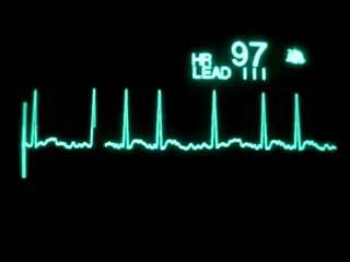 Klinik Değerlendirme Sınıf I Elektrokardiyografik