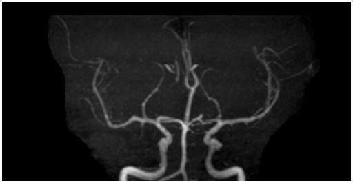 eden sol posterior inferior serebellar arter anevrizması (kalın ok) izlenmektedir. ġekil 4.